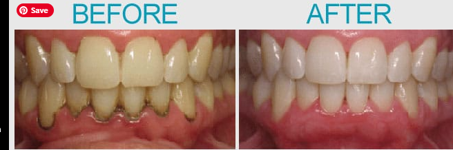 Before After Results