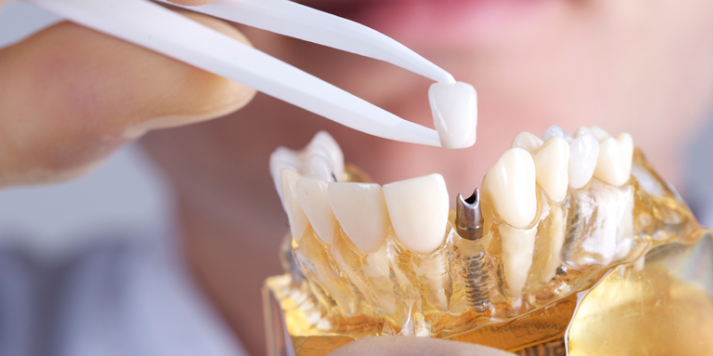 Dental Implants